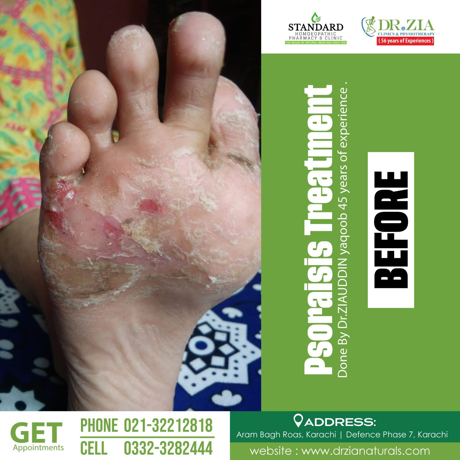 Eczema & Psoriasis Relief Ointment – Natural Healing Formula 50gms